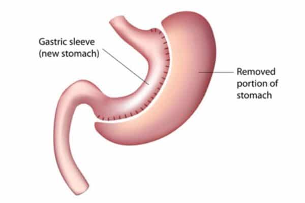 Gastric Sleeve