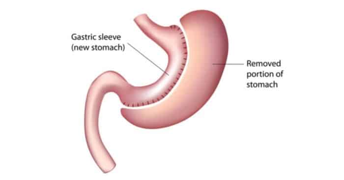 Gastric Sleeve