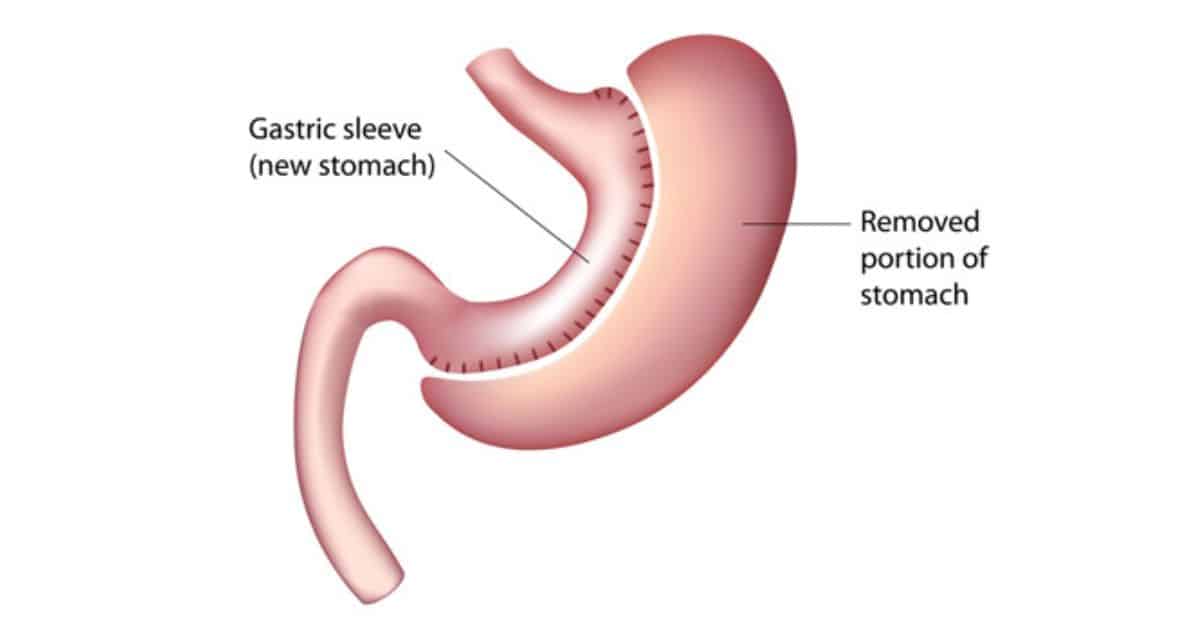 Gastric Sleeve