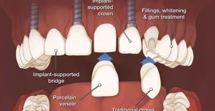 Full Mouth Reconstruction