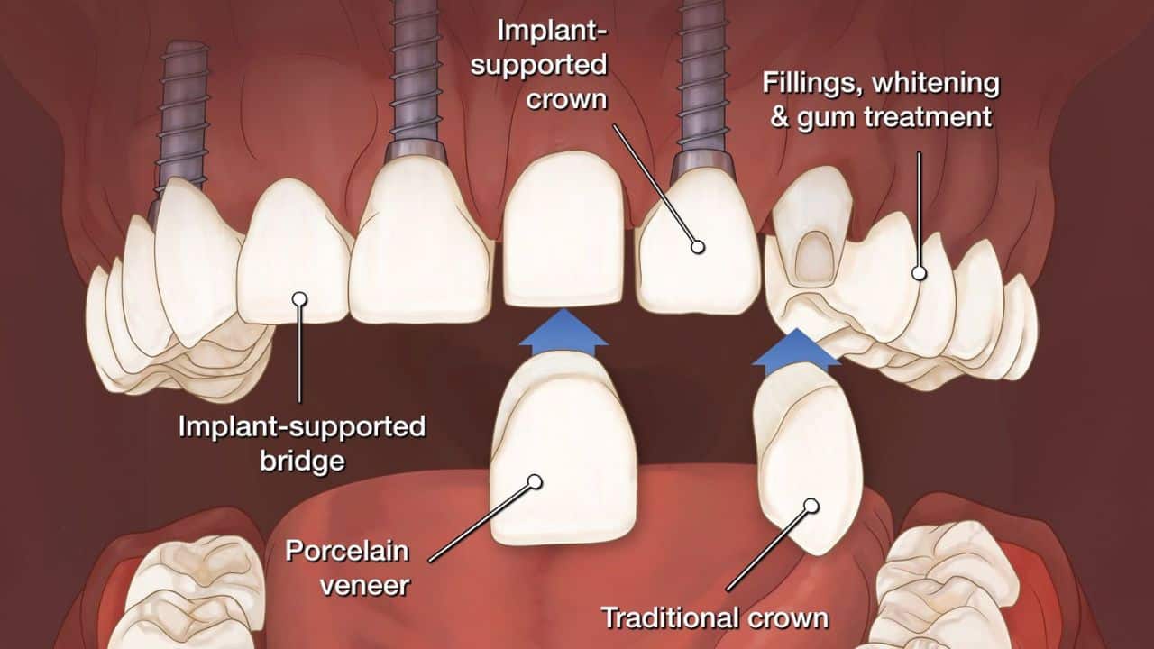 Full Mouth Reconstruction