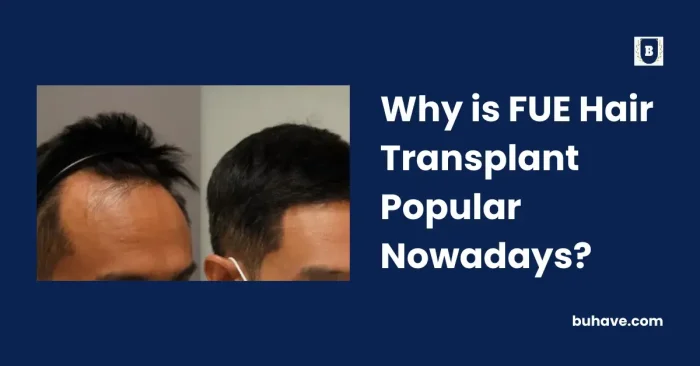 Why is FUE Hair Transplant Popular Nowadays