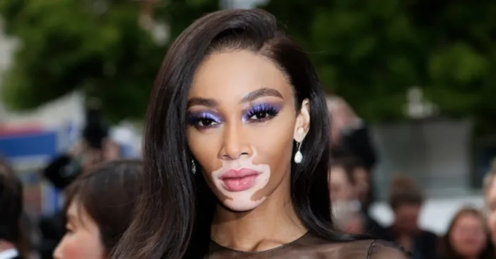 Winnie Harlow Biography